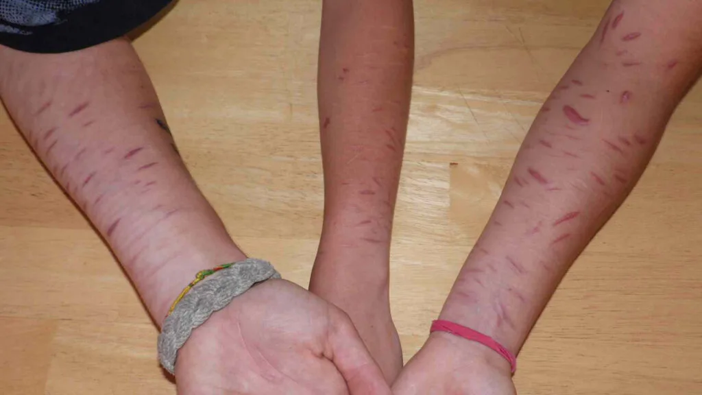 Alerta en Chiquinquirá por peligrosa práctica de Cutting entre niños y jóvenes